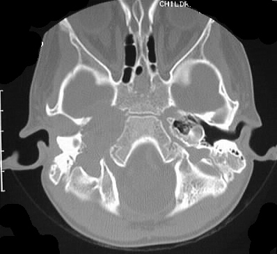 Rhabdomyosarcoma